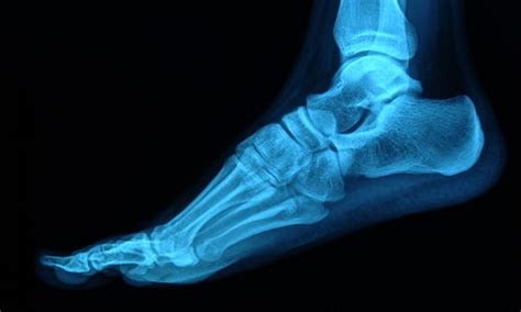 Gout And Bone Erosion — Experiments On Battling Gout