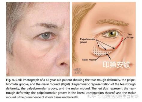 如何区分卧蚕、眼袋和泪沟？ 知乎