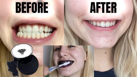 I Used Charcoal To Whiten My Teeth In 1 Week Before And After Pics