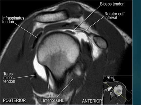 Rotator Cuff MRI Images