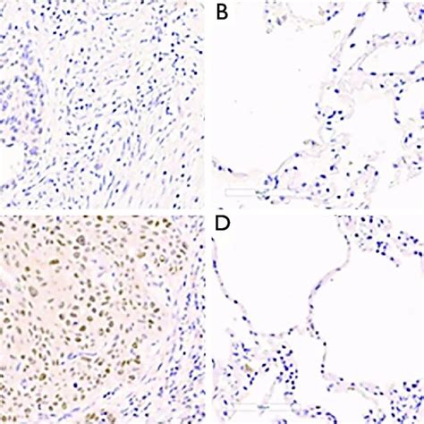 C Myc Expression In Nsclc Tissue And Paired Normal Respiratory