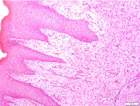 Epulis Histology