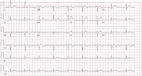 Refractory Ventricular Fibrillation Successfully Cardioverted With Dual