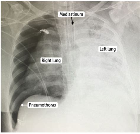 Pleural Effusion Flashcards Quizlet