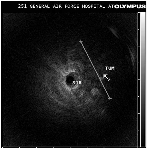 Usefulness Of Endobronchial Ultrasound Ebus In The Diagnosis Of