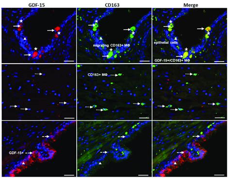 Double Immunofluorescence Of Pca Using Gdf Cy Red And Cd