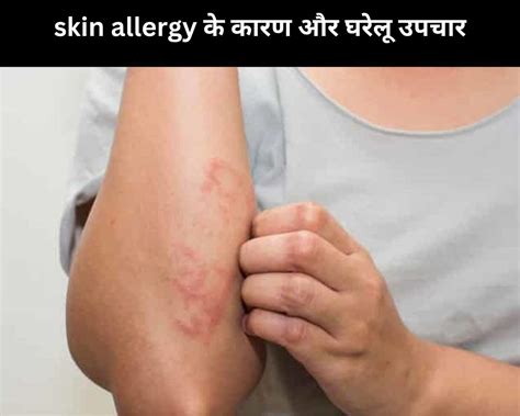 Skin Allergy 4 Causes And 5 Home Remedies In Hindi Skin Allergy के 4 कारण और 5 घरेलू उपचार