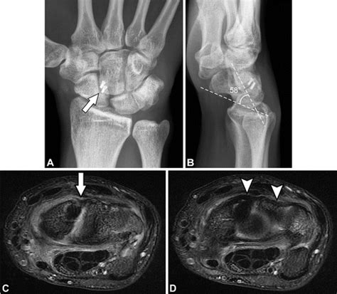 Preoperative And Postoperative Imaging Of Scapholunate Ligament Primary