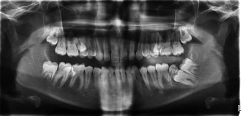 Rare Combination Of Paramolar And Distomolar Supernumerary Teeth In A