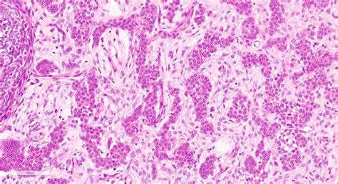 Peripheral Ameloblastoma Histology