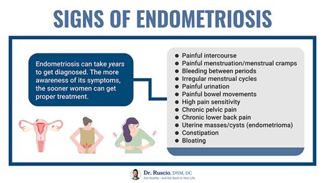 Bowel Endometriosis Symptoms: A Natural Treatment Guide