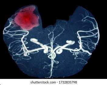 Mra Brain Magnetic Resonance Angiography Image Stock Photo