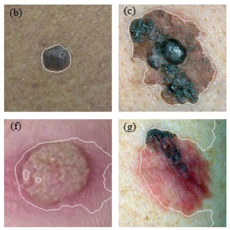 Three Examples Of Pigmented Skin Lesions A Melanoma B Seborrheic