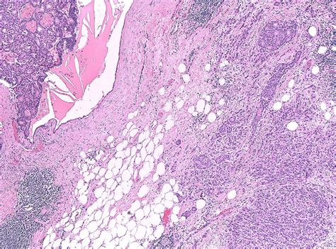 Figure 3 From Encapsulated Papillary Carcinoma Of The Breast Semantic Scholar