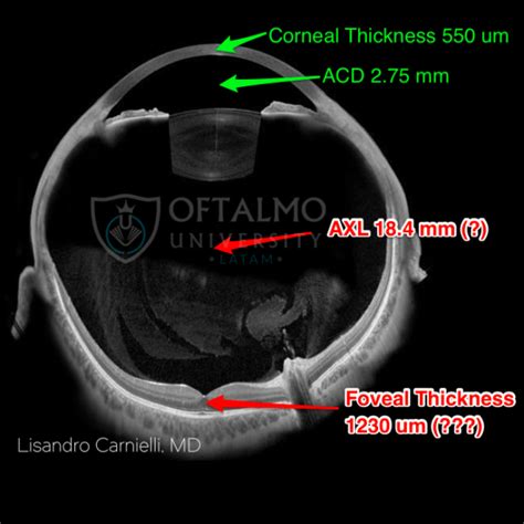 Whole Eye Oct Corregido Oftalmo University