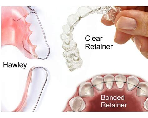 What You Should Know About Retainers Odontovida