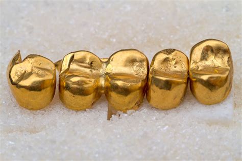 What Is a Gold Dental Crown?