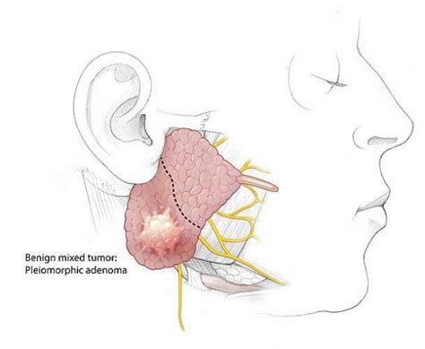 Salivary Gland Head And Neck Surgery Stanford Otolaryngology — Head