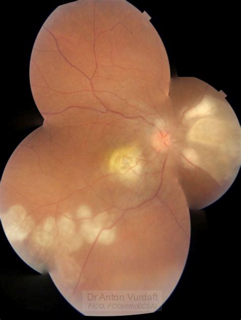 Probable Intraocular Tuberculosis Tropical Ophthalmology