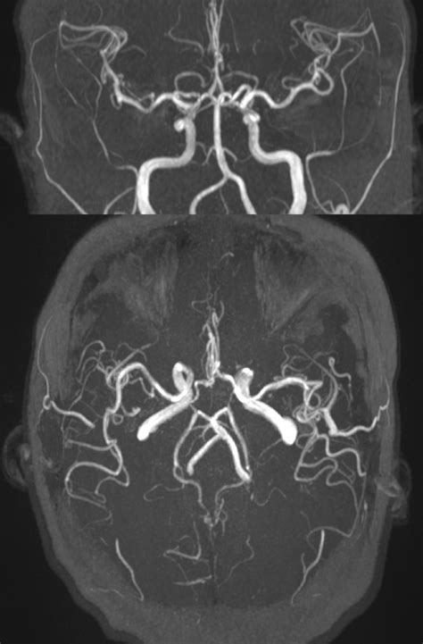 Mr Angiogram Statpearls Ncbi Bookshelf