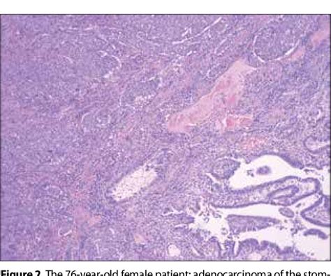 Figure From Synchronous Adenocarcinoma And Gastrointestinal Stromal