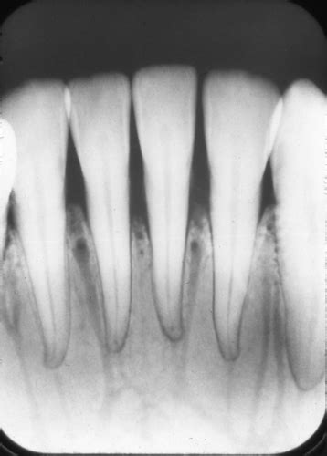 Anatomy Monday Vascular Nutrient Canals Mandible Dr G S Toothpix