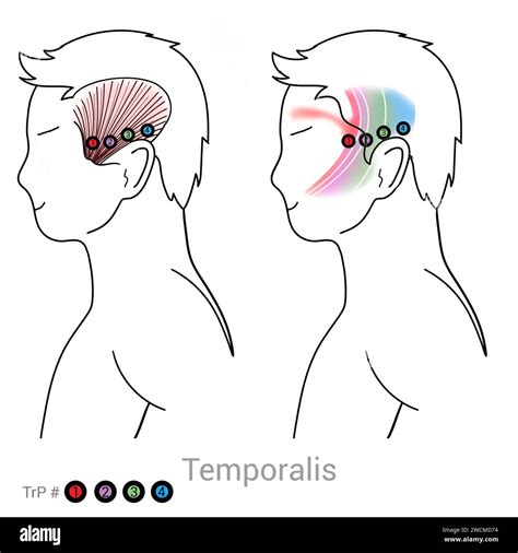 Temporalis Myofascial Trigger Points And Associated Pain Locations