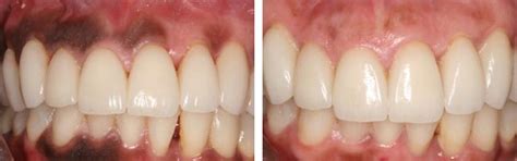 Laser Gum Depigmentation Kordel House Dental Practice