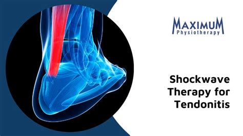 Shockwave Therapy For Tendonitis Healthy Safe And Successful Pain Relief