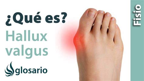 Hallux Valgus Qu Es Youtube