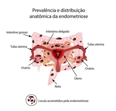 Tudo O Que Voc Precisa Saber Sobre Endometriose Profunda