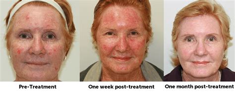 Daylight Photodynamic Therapy A New Way To Treat Sun Damage