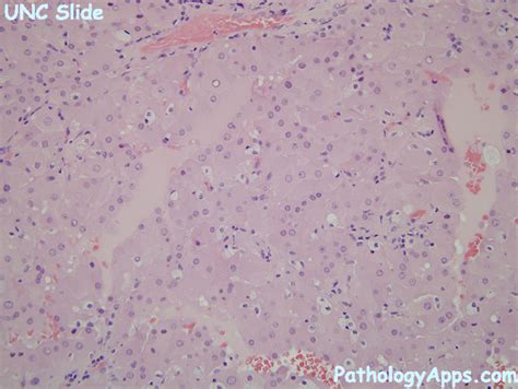 Acquired Rcc Pathology