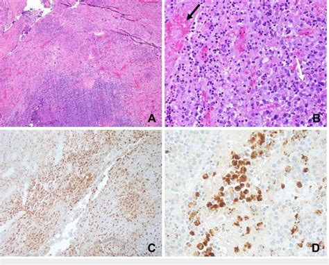 Excisional Lymph Node Biopsy A Extensive Necrosis Pink 40x B