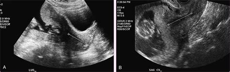 Placenta Previa And Accreta Vasa Previa Subchorionic Hemorrhage And