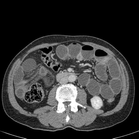 The Radiology Assistant Closed Loop Obstruction In Small Bowel Obstruction