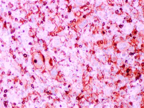 Immunohistochemical Stain For Cd Shows Diffuse Membranous Staining Of