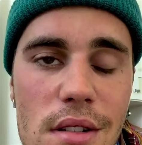 Canadian Singer Justin Bieber Suffers Face Paralysis The Maravi Post