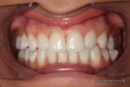 Emax Veneers Gallery 3 - Pearl Dental Clinic