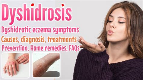 Dyshidrosis Overview Causes Symptoms Diagnoses Treatment Home