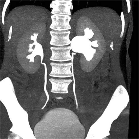 Pyelo Ureteral Junction Stenosis Eurorad