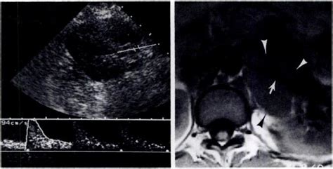 Patient Is Placed In Left Posterior Oblique Position And Cursor Is