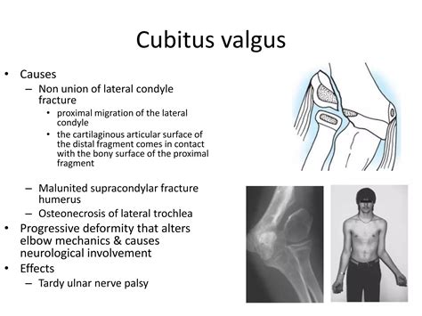 Osteotomy Around Elbow Ppt