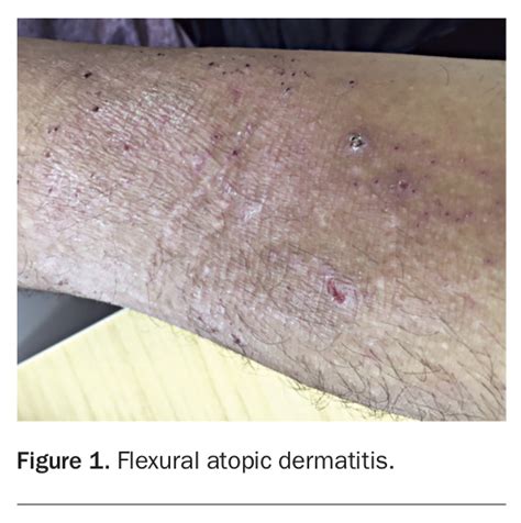 Biologics New Therapy For Atopic Dermatitis Medicine Today