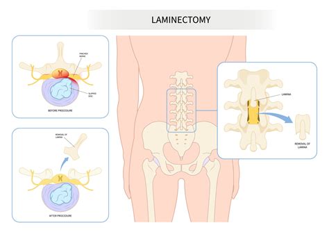 Spinal Solutions Laminectomy