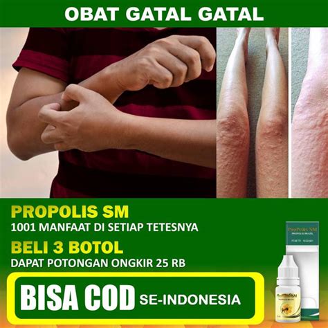 Obat Gatal Kulit Jamur Kulit Kulit Gatal Bersisik Eksim Eksim Basah