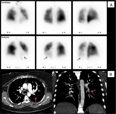 Initial Diagnostic Procedures A Pulmonary Ventilation Perfusion Scan