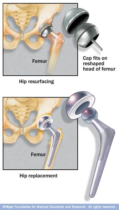 Hip Resurfacing Mayo Clinic