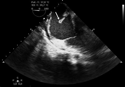 Transesophageal Echocardiography Modified Midesophageal Fourchamber