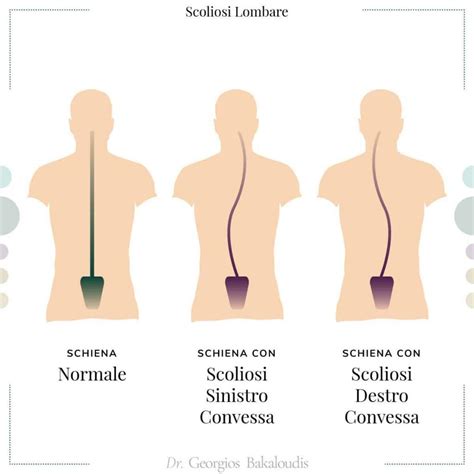 Scoliosi Lombare Tipologie Esercizi Busto E Intervento Chirurgico